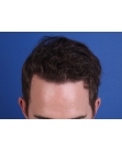After Hair Transplant&nbsp;Front